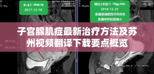 子宫腺肌症最新治疗方法及苏州视频翻译下载要点概览
